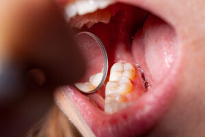 temporary filling of a patients dental caries set by a dentist for the treatment of gingivitis in the dentists office