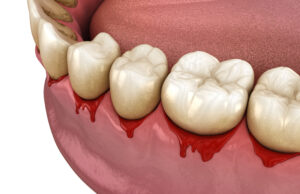 Bleeding gums or Periodontal - pathological inflammatory condition of the gum and bone support. Dental 3D illustration