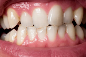 Close up shot of human uneven teeth with some tartar.