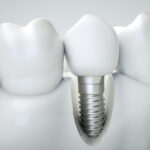 Dental implant on the example of a jaw model