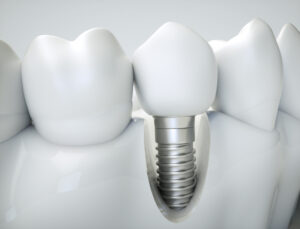 Dental implant on the example of a jaw model