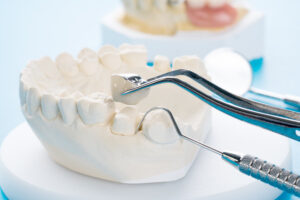 Close up Implan model tooth support fix bridge implan and crown.