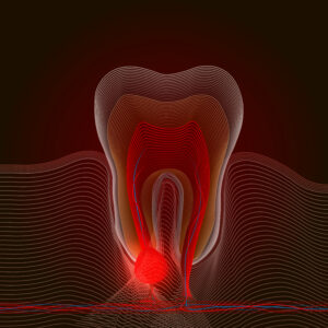 Linear stylization of dental disease with a point of pain and inflammation. Medical illustration of tooth root inflammation, tooth root cyst, pulpitis. X-ray effect 10 eps