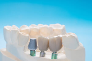 Close up Implant model tooth support fix bridge implant and crown.
