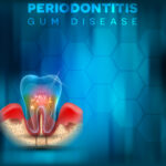 Periodontitis gum disease poster, inflammation of the gums on a bright blue mesh background