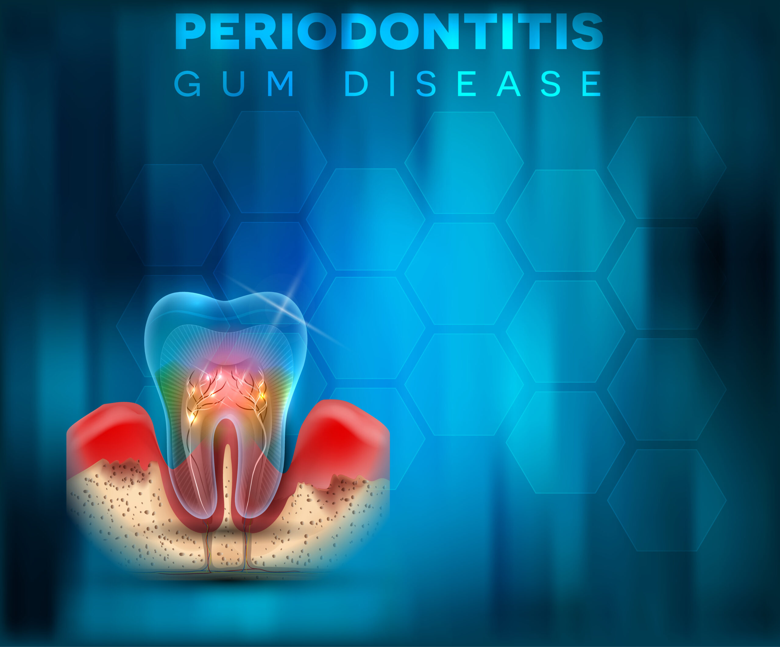 Periodontitis gum disease poster, inflammation of the gums on a bright blue mesh background