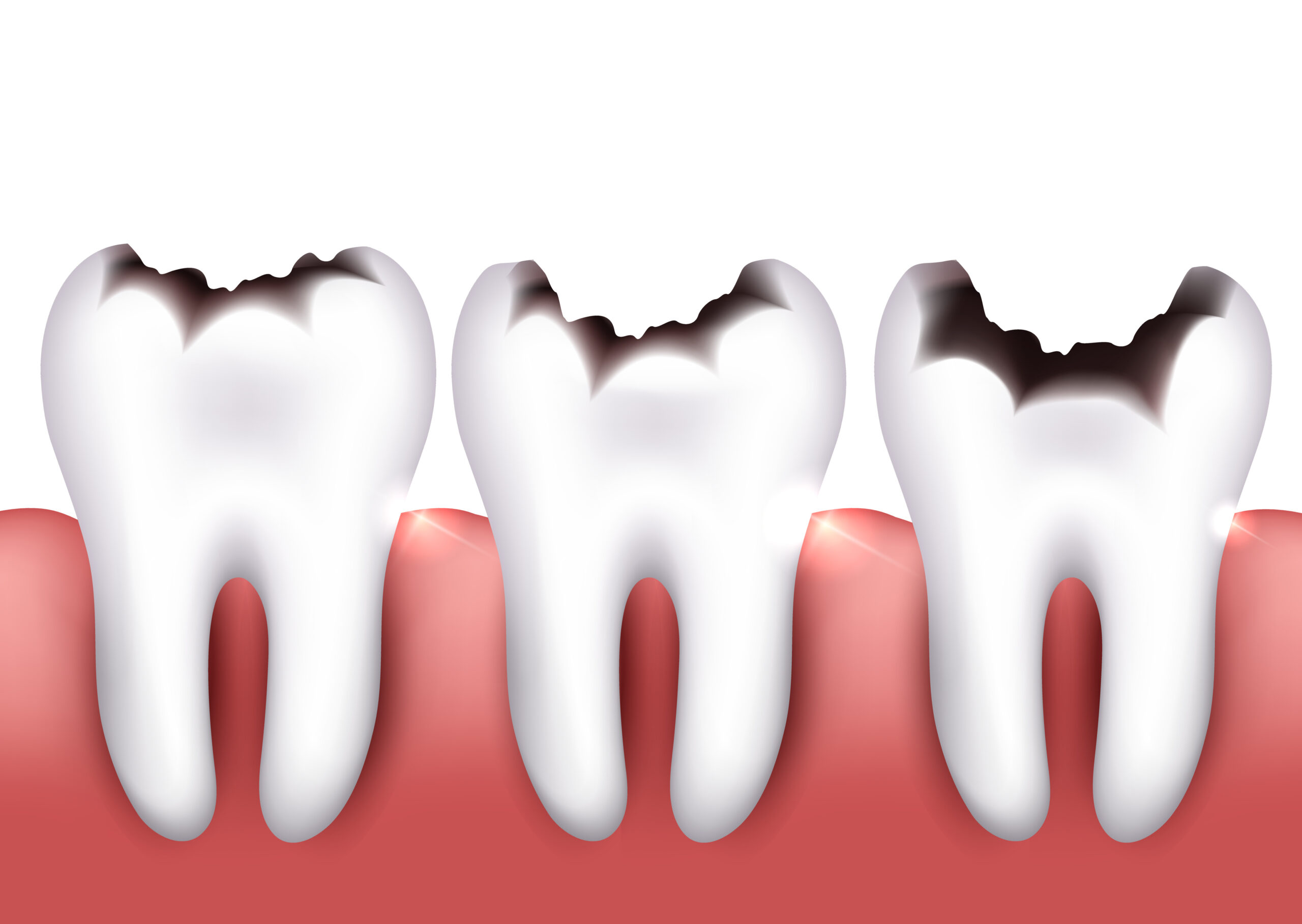 Dental caries, tooth decay, health problem.
