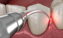 north hollywood dental laser