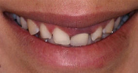 Dentist North Hollywood - Cosmetic Veneer